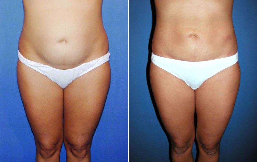 Liposuction Case # 135