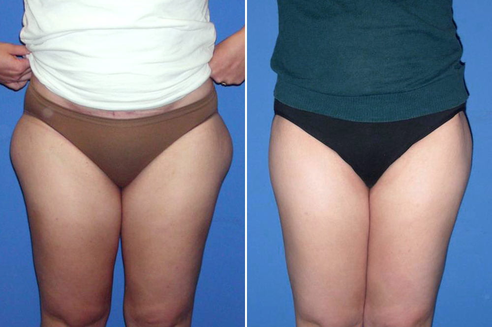 Liposuction Case # 137