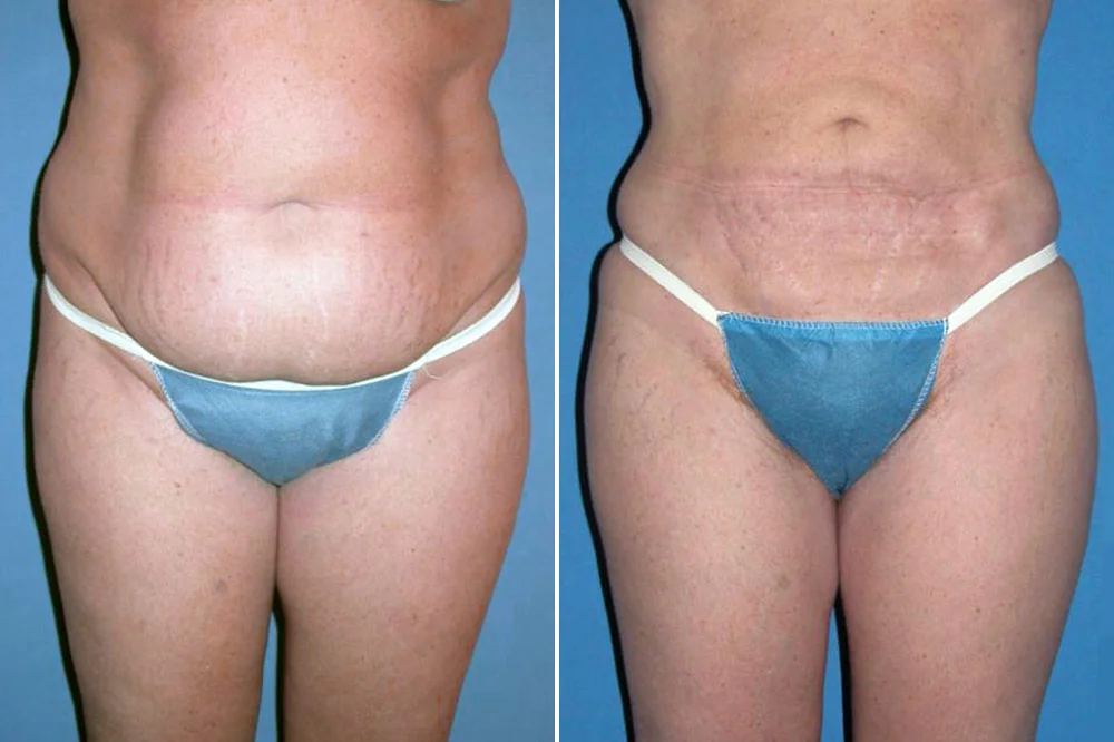 Liposuction: How much fat can you take out?
