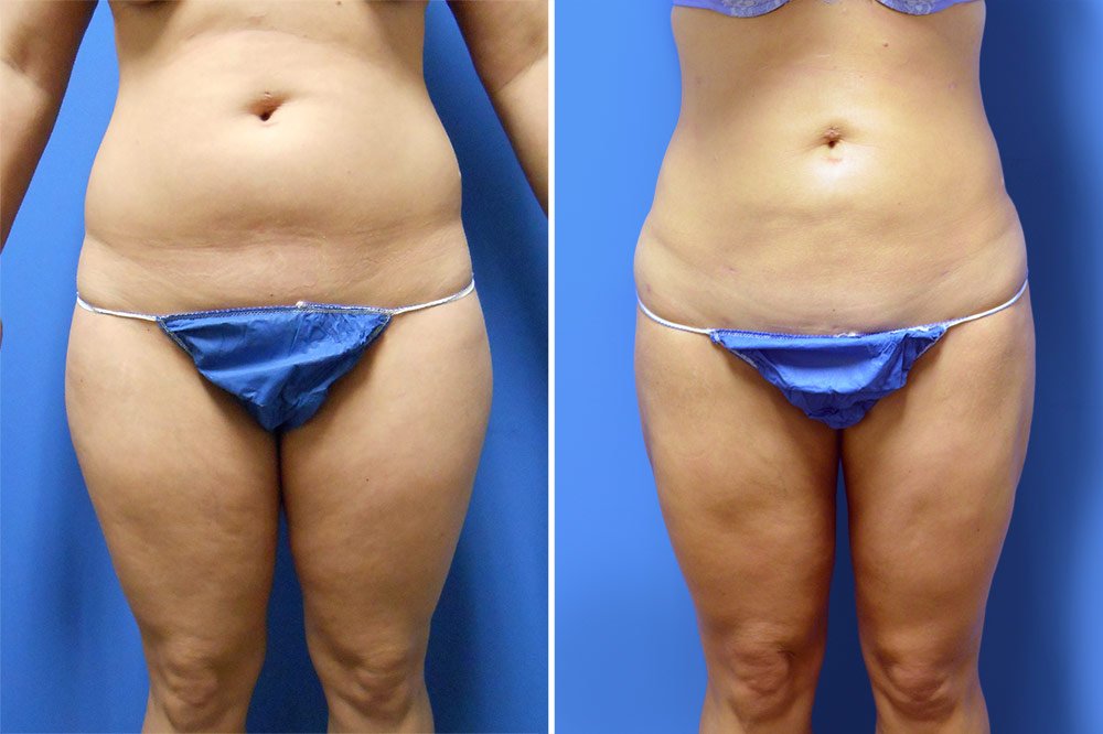 Liposuction Case # 150