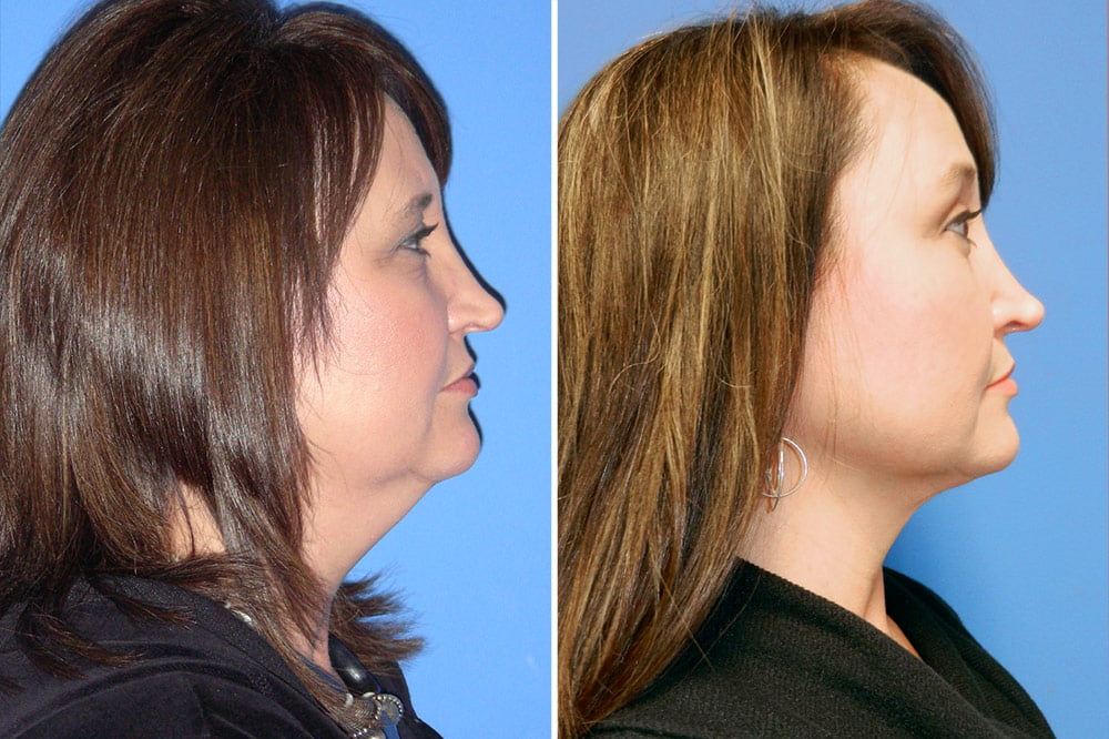 Before and after neck liposuction in Little Rock with Dr. Rhys Branman