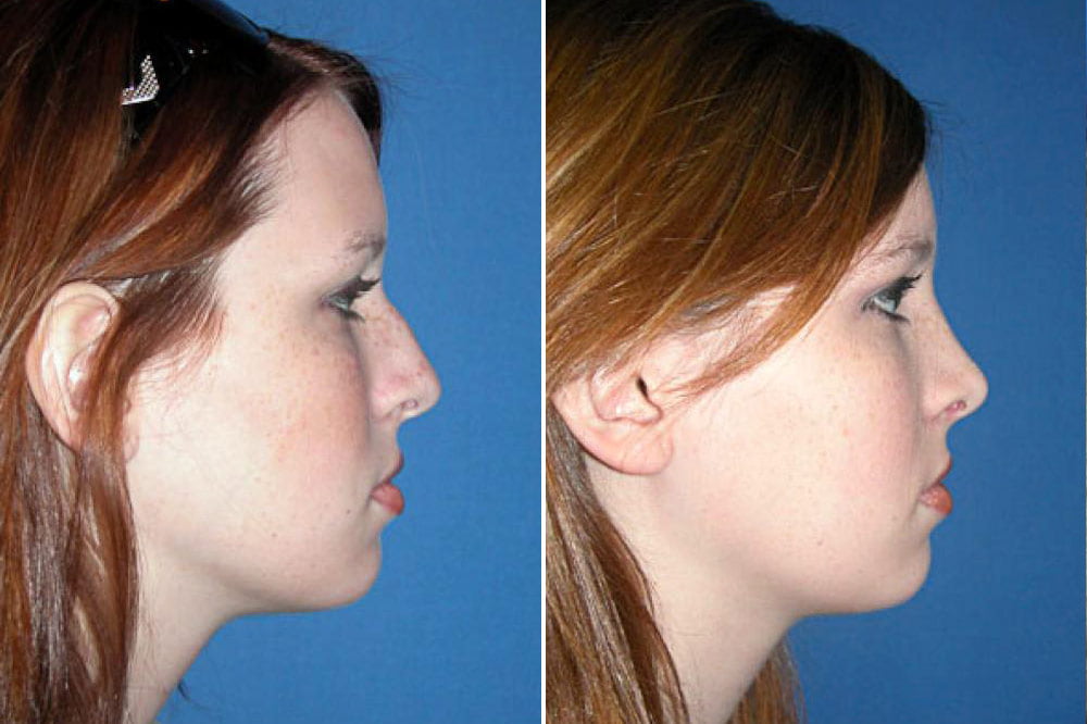 Rhinoplasty Case # 132