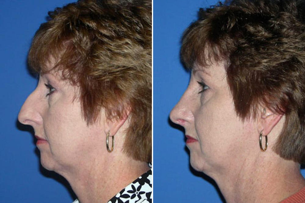 Rhinoplasty Case # 133