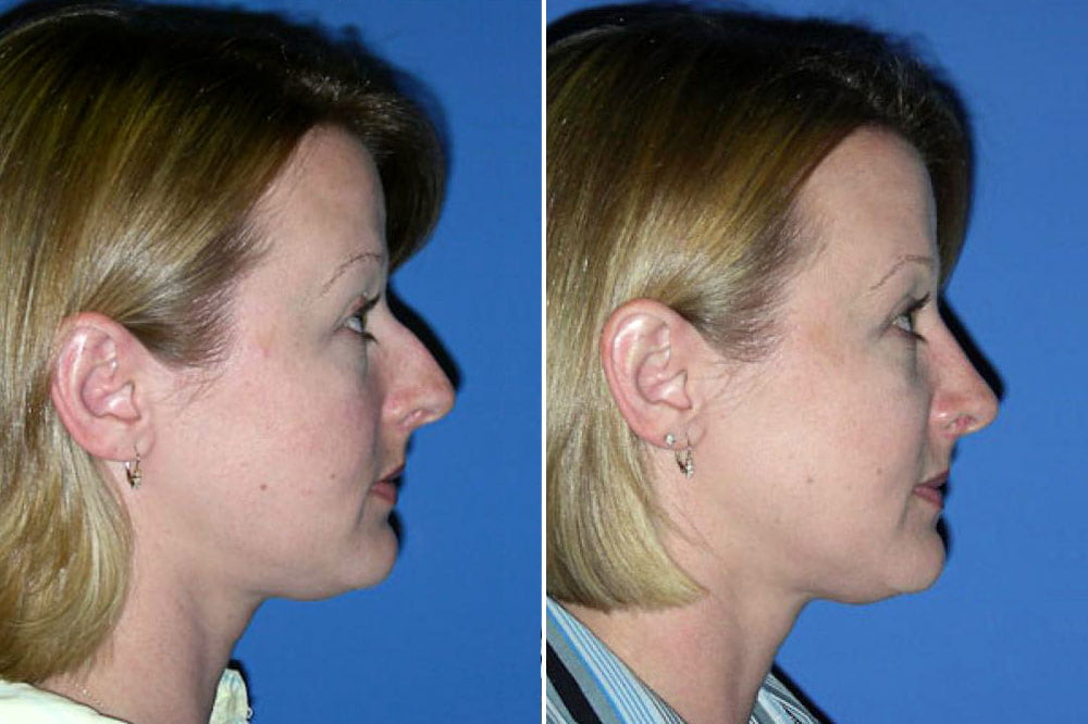 Rhinoplasty Case # 134