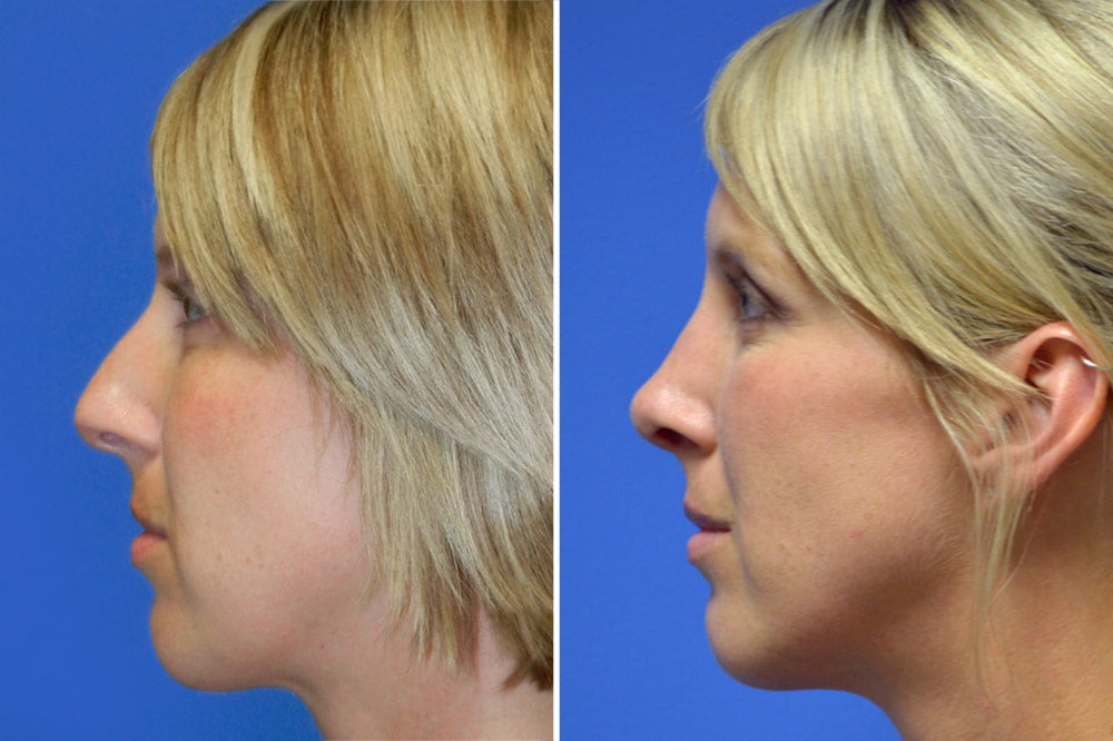 Rhinoplasty Case # 150