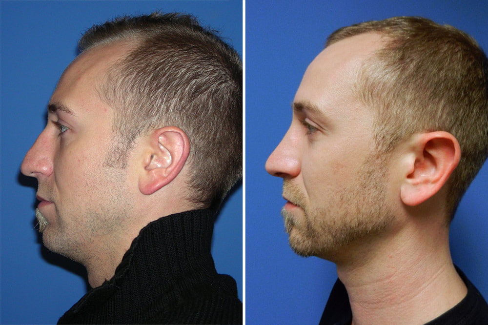 Rhinoplasty Case # 151