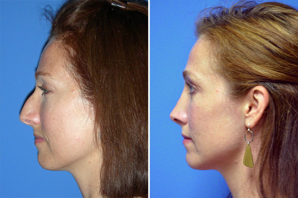 Rhinoplasty Case # 152