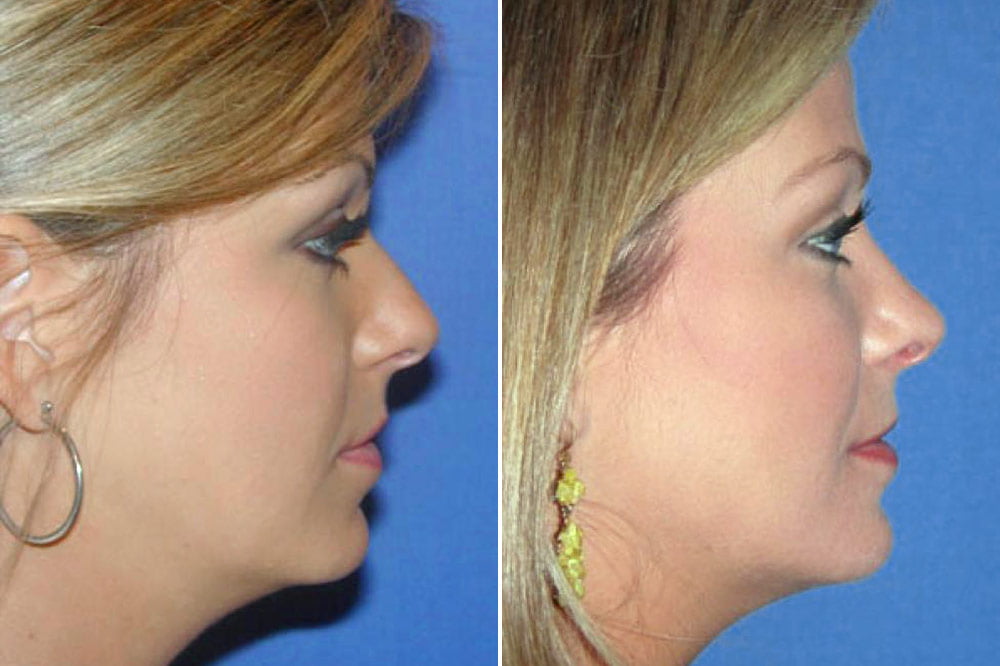 Rhinoplasty Case # 130