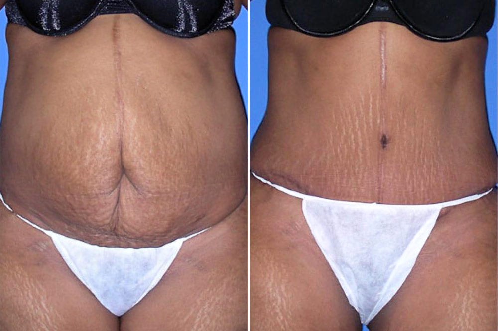 Tummy Tuck Case # 103