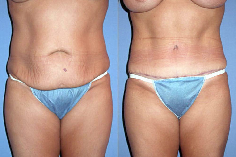 Tummy Tuck Case # 104