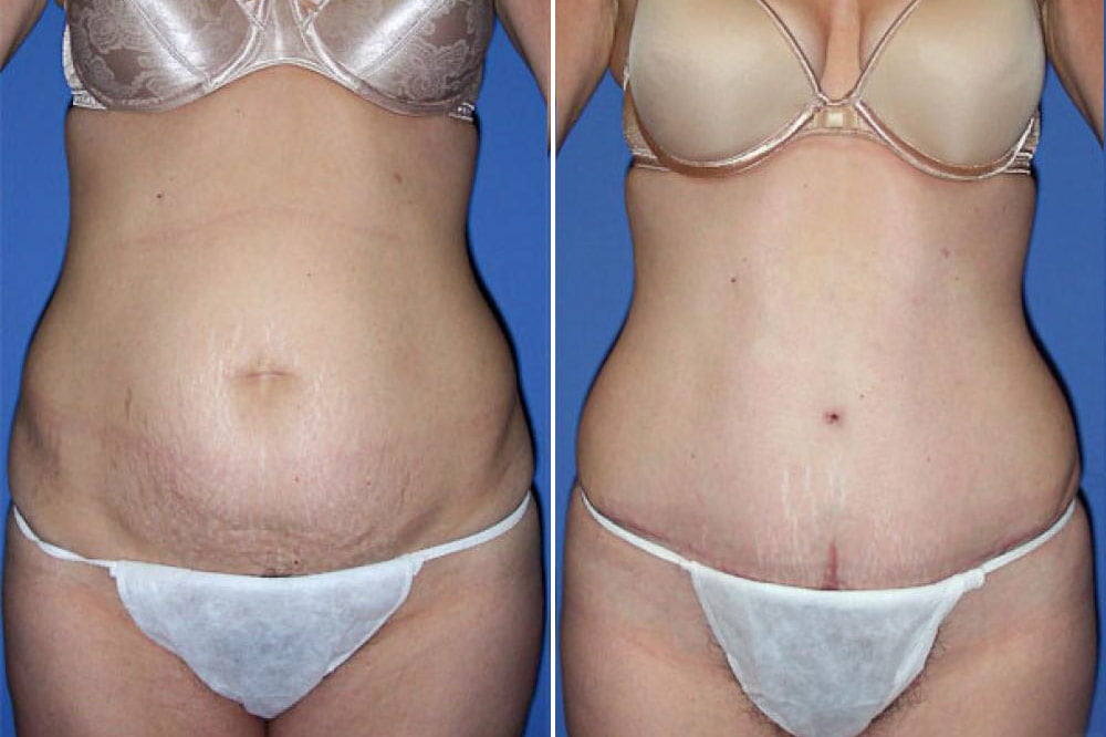 Tummy Tuck Case # 105