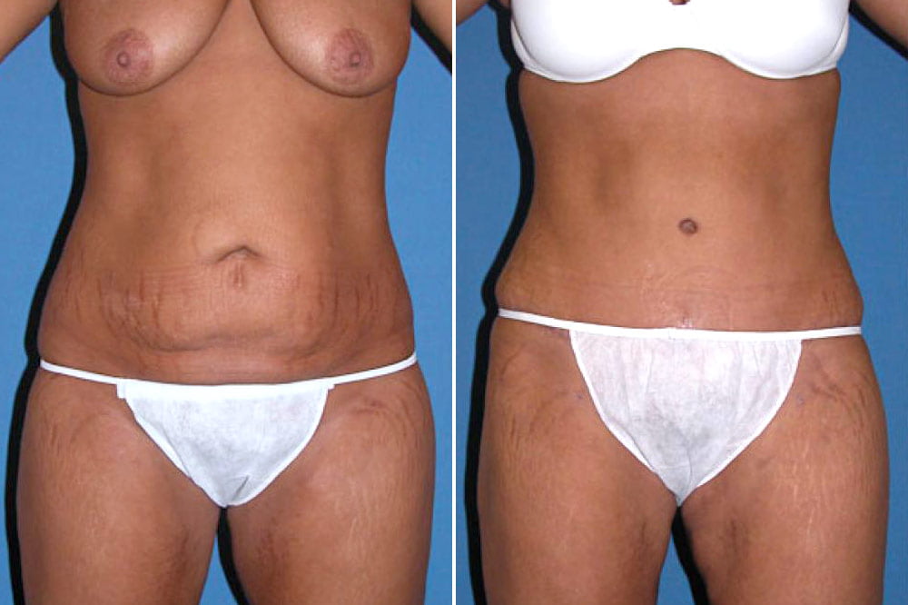 Tummy Tuck Case # 106