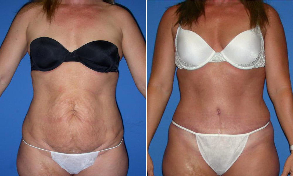 Tummy Tuck Case # 154