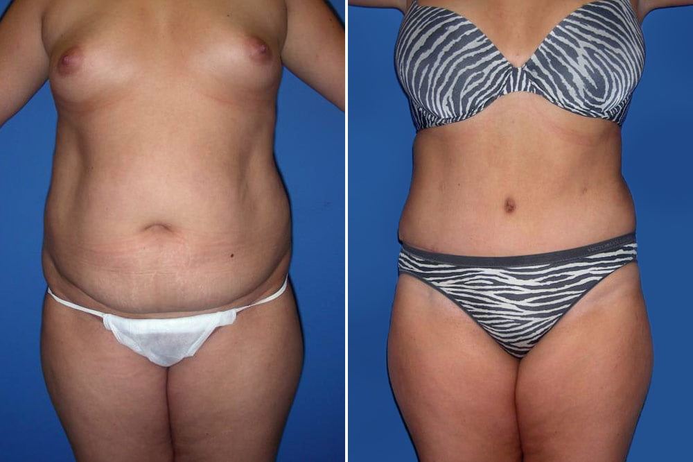 Tummy Tuck Case # 158