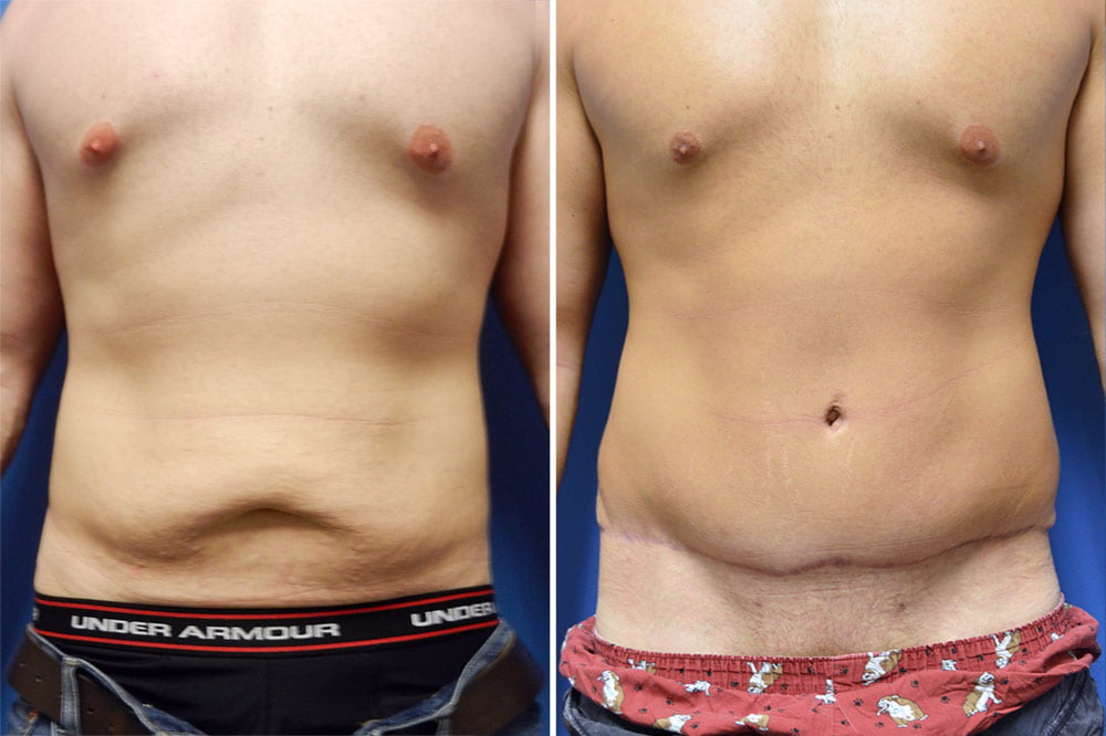 Tummy Tuck Case # 201