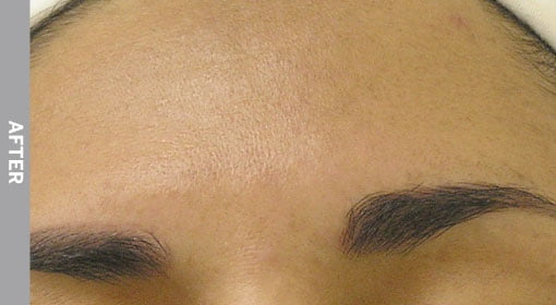 Hyperpigmentation-After