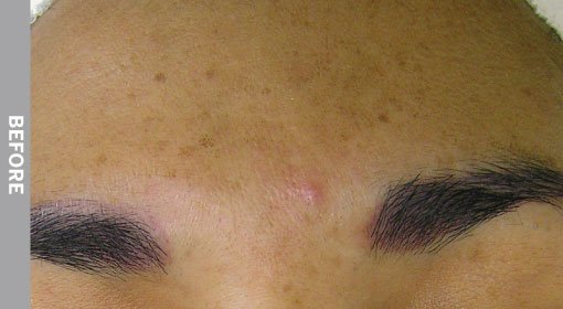Hyperpigmentation before hydrafacial treatment