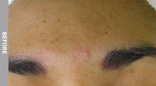 Hyperpigmentation-Before