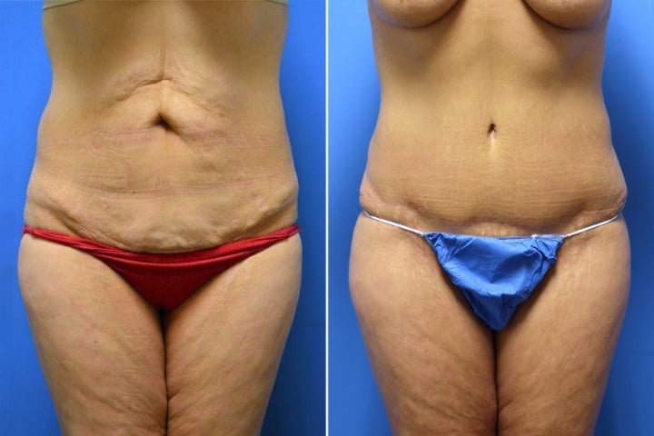 Tummy Tuck Case # 210