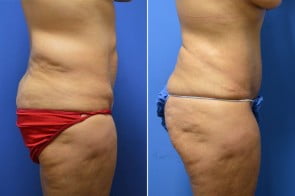 abdominoplasty-01c-branman