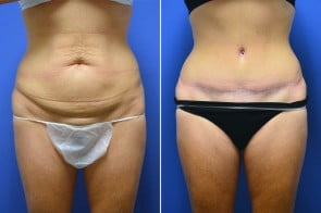 abdominoplasty-02a-branman