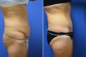 abdominoplasty-02c-branman