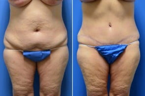 abdominoplasty-03a-branman