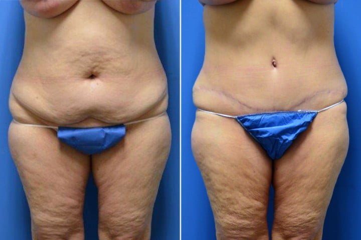 Tummy Tuck Case # 212