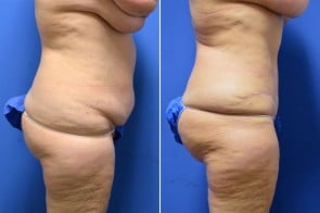 abdominoplasty-03c-branman