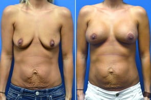 breast-augmentation-04a-branman