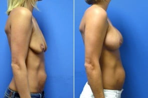 breast-augmentation-04c-branman