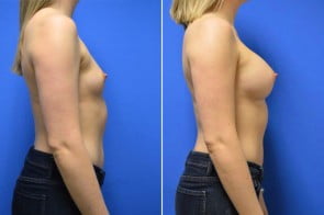 breast-augmentation-07c-branman