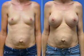 breast-augmentation-09a-branman