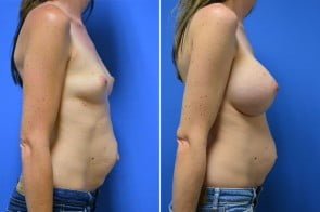 breast-augmentation-09c-branman