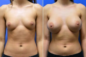 breast-augmentation-10a-branman