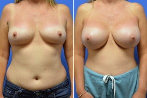 breast-augmentation-16a-branman