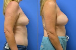 breast-augmentation-16c-branman
