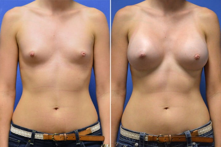 Breast Augmentation Case # 228