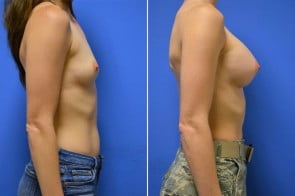 breast-augmentation-234c-branman