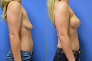 breast-augmentation-24c-branman