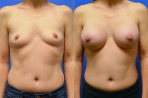 breast-augmentation-26a-branman