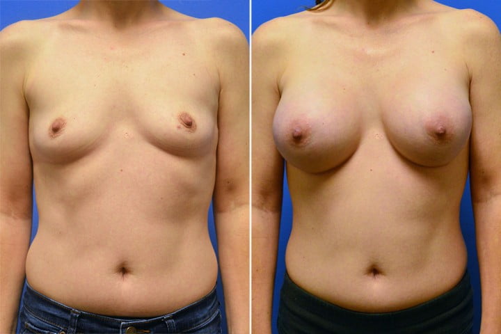 Breast Augmentation Case # 230