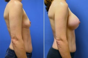 breast-augmentation-26c-branman