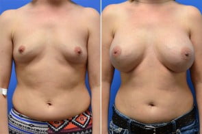 breast-augmentation-29a-branman