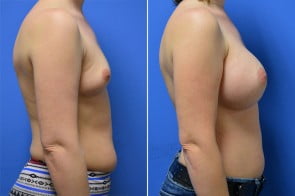 breast-augmentation-29c-branman