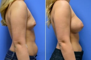 breast-augmentation-32c-branman