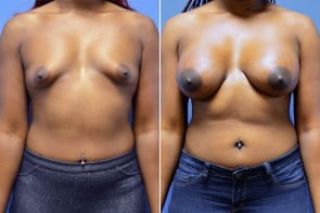 breast-augmentation-33a-branman