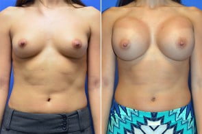 breast-augmentation-3a-branman