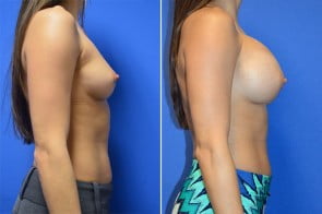 breast-augmentation-3c-branman