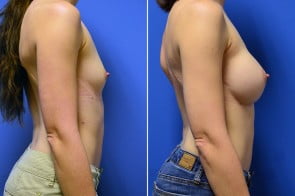 breast-augmentation-5c-branman